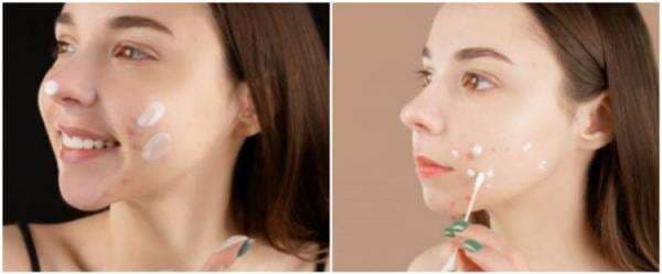 9 Skincare untuk menghilangkan bekas jerawat di bawah Rp 150 ribu 9 Skincare untuk menghilangkan bekas jerawat di bawah Rp 150 ribu