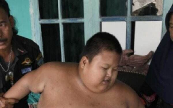 Bocah di Bekasi Meninggal Akibat Obesitas, Begini Tanggapan Dokter