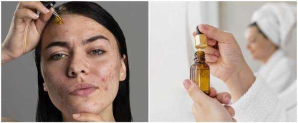 3 Produk Eiem Beauty Serum, bisa atasi jerawat 3 Produk Eiem Beauty Serum, bisa atasi jerawat