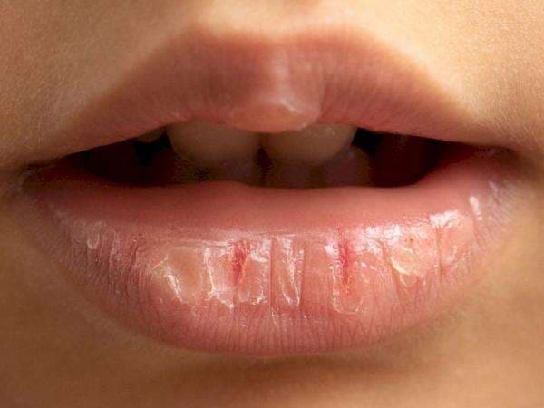 Jilati Bibir yang Kering saat Puasa hanya Bikin Bibir Tambah Kering, Ini Sebabnya Jilati Bibir yang Kering saat Puasa hanya Bikin Bibir Tambah Kering, Ini Sebabnya