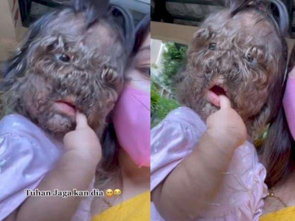 Mengenal Hypertrichosis, Sindrom Langka yang Bikin Wajah Balita Ini Penuh dengan Rambut Mengenal Hypertrichosis, Sindrom Langka yang Bikin Wajah Balita Ini Penuh dengan Rambut