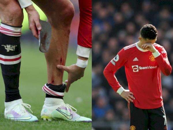 MU Kalah, Kaki Ronaldo Berdarah hingga Berujung Banting HP Fans Everton MU Kalah, Kaki Ronaldo Berdarah hingga Berujung Banting HP Fans Everton