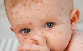 4 Cara Menghilangkan Bekas Cacar Air di Wajah yang Sudah Berlubang secara Alami 4 Cara Menghilangkan Bekas Cacar Air di Wajah yang Sudah Berlubang secara Alami