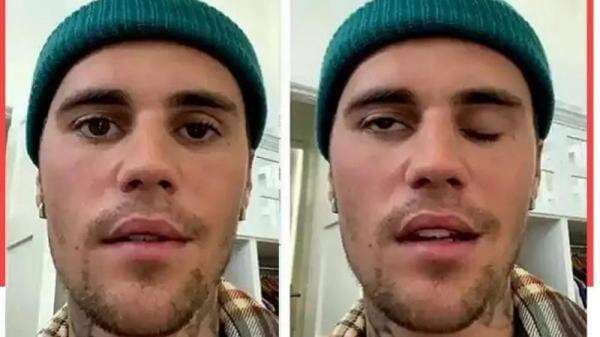 Mengenal Gejala Ramsay Hunt Syndrome yang Pernah Dialami Justin Bieber, Hati-Hati Jika Timbul Ruam Merah Mengenal Gejala Ramsay Hunt Syndrome yang Pernah Dialami Justin Bieber, Hati-Hati Jika Timbul Ruam Merah