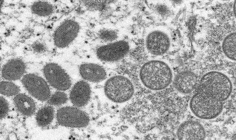 Ilmuwan Sebut Virus Monkeypox Telah Bermutasi Lebih Banyak dari Perkiraan