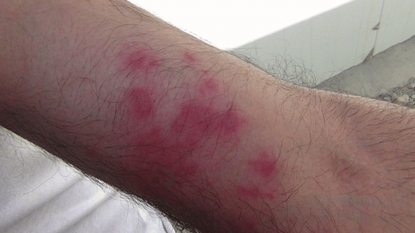 Gigitan Kutu Kasur Apakah Bisa Berbahaya? Ini Gejala dan Pengobatannya Gigitan Kutu Kasur Apakah Bisa Berbahaya? Ini Gejala dan Pengobatannya