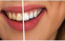 Kenali 5 Bahan Rumahan yang Tak Terbukti Efektif Hilangkan Karang Gigi