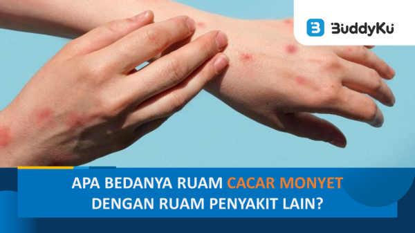 Buddies Harus Tahu! Ini Perbedaan Ruam Cacar Monyet dengan Penyakit Lain Buddies Harus Tahu! Ini Perbedaan Ruam Cacar Monyet dengan Penyakit Lain