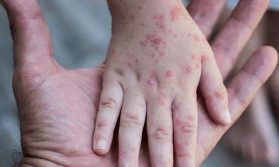 Pengertian Pseudo Pustula pada Cacar Monyet dan Gejalanya Pengertian Pseudo Pustula pada Cacar Monyet dan Gejalanya