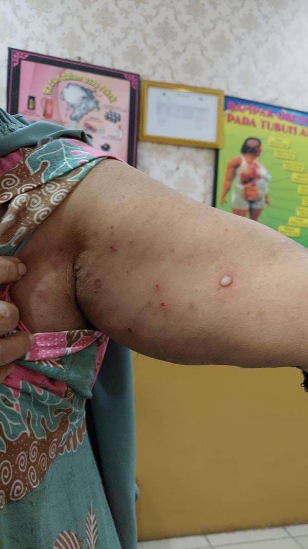 Wanita Lansia Asal Cilegon Suspect Cacar Monyet (monkeypox), Begini Kondisinya