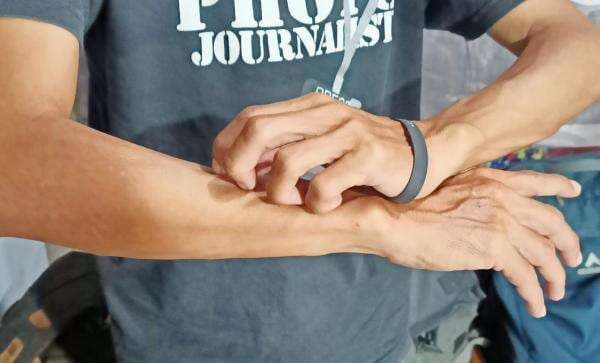 Muncul Bintik Merah dan Gatal di Bagian Tangan? Coba Obati dengan 6 Cara Ini Muncul Bintik Merah dan Gatal di Bagian Tangan? Coba Obati dengan 6 Cara Ini