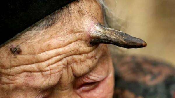 Kisah Zhang Ruifang, Nenek Bertanduk Setan di Dahinya Kisah Zhang Ruifang, Nenek Bertanduk Setan di Dahinya