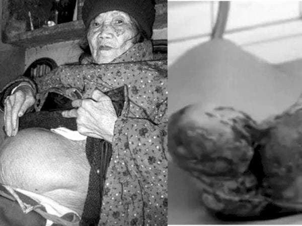 Kisah Tragis Huang Yijun: Wanita yang Hamil Selama 60 Tahun dan Melahirkan 'Bayi Mumi' Kisah Tragis Huang Yijun: Wanita yang Hamil Selama 60 Tahun dan Melahirkan 'Bayi Mumi'