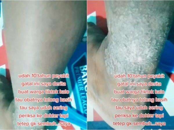 Diduga Lichen Simplex Chronicus, Penyakit Gatal-gatal Pria Ini Gak Kunjung Sembuh Diduga Lichen Simplex Chronicus, Penyakit Gatal-gatal Pria Ini Gak Kunjung Sembuh