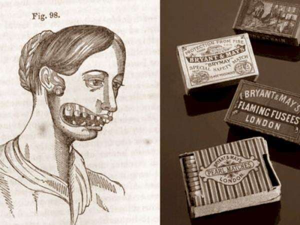 Sejarah Kelam Korek Api: Ketika Rahang Gadis Pekerja 'Dibiarkan' Busuk Demi Produksi Sejarah Kelam Korek Api: Ketika Rahang Gadis Pekerja 'Dibiarkan' Busuk Demi Produksi