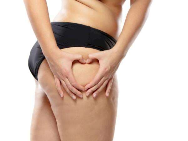 6 Cara Memudarkan Stretch Mark Pada Bokong, Lakukan Secara Rutin! 6 Cara Memudarkan Stretch Mark Pada Bokong, Lakukan Secara Rutin!