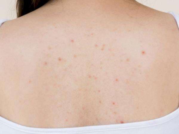 10 Cara Menghilangkan Jerawat di Punggung Tanpa Bekas, Ampuh! 10 Cara Menghilangkan Jerawat di Punggung Tanpa Bekas, Ampuh!