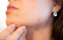 4 Cara Menghilangkan Komedo dengan Lebih Aman, Solusi untuk Tak Pakai Pasta Gigi 4 Cara Menghilangkan Komedo dengan Lebih Aman, Solusi untuk Tak Pakai Pasta Gigi