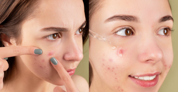 Beautypedia: Succinic Acid, Solusi Jerawat untuk Pemilik Kulit Sensitif Beautypedia: Succinic Acid, Solusi Jerawat untuk Pemilik Kulit Sensitif