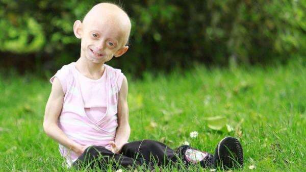 Apa Itu Sindrom Progeria? Ini Gejala, Penyebab, dan Faktor Risikonya Apa Itu Sindrom Progeria? Ini Gejala, Penyebab, dan Faktor Risikonya
