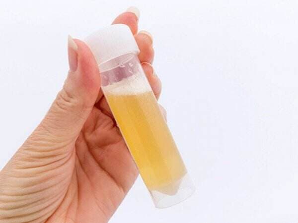 4 Penyebab Urine Berbusa, Waspadai Kondisi Ini