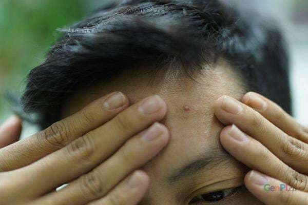 Apakah Jerawat Bisa Sembuh dengan Cara Dipencet? Ini Penjelasan Dokter Apakah Jerawat Bisa Sembuh dengan Cara Dipencet? Ini Penjelasan Dokter