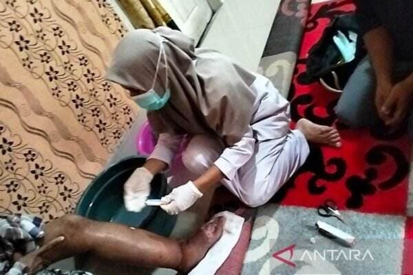 16 Warga Nagan Raya Aceh Menderita Penyakit Kaki Gajah Stadium 5