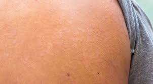 Penyebab, Gejala dan Pengobatan Panu pada Kulit Penyebab, Gejala dan Pengobatan Panu pada Kulit