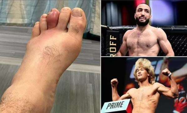 Mengerikan! Penampakan Cedera Horor Belal Muhammad akibat Infeksi Tulang Mengerikan! Penampakan Cedera Horor Belal Muhammad akibat Infeksi Tulang