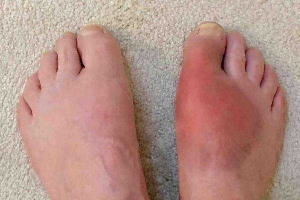 5 Gejala Asam Urat yang Sering Tidak Disadari, Tak Melulu Nyeri Sendi 5 Gejala Asam Urat yang Sering Tidak Disadari, Tak Melulu Nyeri Sendi