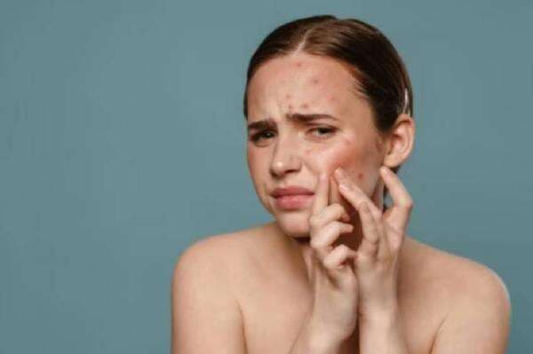 6 Cara Menghilangkan Jerawat, Nomor 3 Paling Mudah 6 Cara Menghilangkan Jerawat, Nomor 3 Paling Mudah