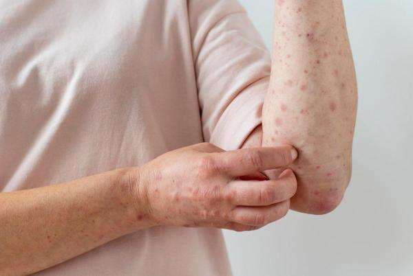 Ciri-Ciri Orang Terkena Lupus, Penyakit Autoimun yang Sulit Dideteksi Ciri-Ciri Orang Terkena Lupus, Penyakit Autoimun yang Sulit Dideteksi