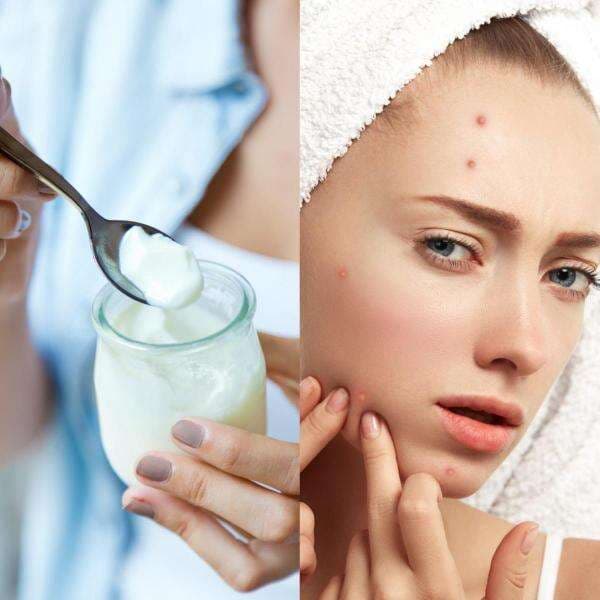 6 Manfaat Probiotik untuk Kesehatan Kulit, Bisa Obati Jerawat hingga Bikin Awet Muda 6 Manfaat Probiotik untuk Kesehatan Kulit, Bisa Obati Jerawat hingga Bikin Awet Muda