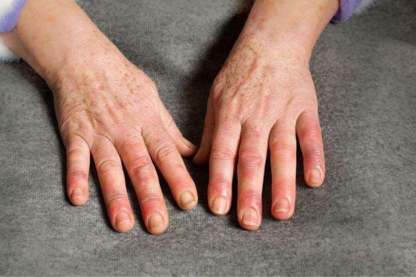 7 Gejala Awal Penyakit Ginjal yang Terlihat dari Kondisi Kaki dan Tangan 7 Gejala Awal Penyakit Ginjal yang Terlihat dari Kondisi Kaki dan Tangan