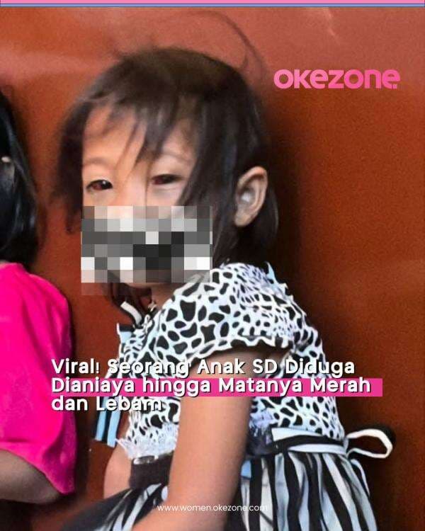 Viral! Anak SD Diduga Dianiaya hingga Matanya Merah dan Lebam Viral! Anak SD Diduga Dianiaya hingga Matanya Merah dan Lebam