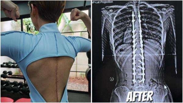 Kondisi Terkini Nada Anak Deddy Corbuzier usai Operasi Skoliosis, Sempat Tidak Bisa Duduk Kondisi Terkini Nada Anak Deddy Corbuzier usai Operasi Skoliosis, Sempat Tidak Bisa Duduk