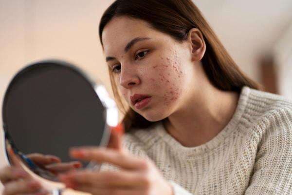 Acne Spot Digunakan Pagi atau Malam? Yuk Simak Penjelasannya Acne Spot Digunakan Pagi atau Malam? Yuk Simak Penjelasannya