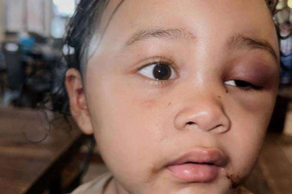 Anak Selebram Aghnia Punjabi Alami Kekerasan hingga Wajah Penuh Lebam, Diduga oleh sang Pengasuh Anak Selebram Aghnia Punjabi Alami Kekerasan hingga Wajah Penuh Lebam, Diduga oleh sang Pengasuh