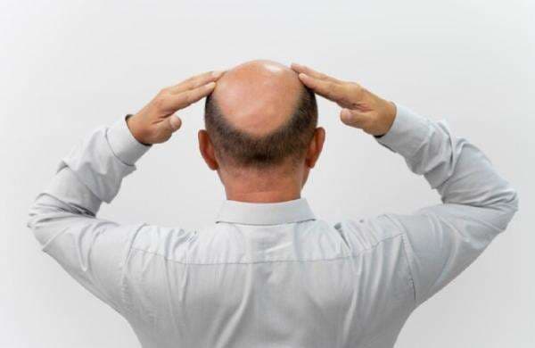 Apa Itu Ophiasis Alopecia? Kenali Penyebab dan Pengobatannya Apa Itu Ophiasis Alopecia? Kenali Penyebab dan Pengobatannya