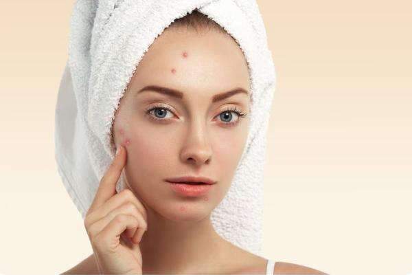 Apakah Vitamin B Dapat Menyebabkan Jerawat? Ini Faktanya Apakah Vitamin B Dapat Menyebabkan Jerawat? Ini Faktanya