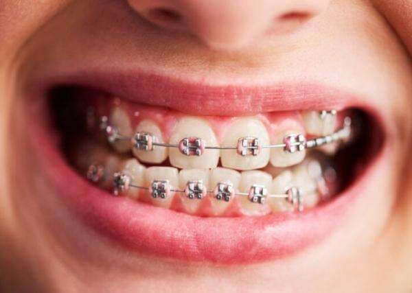 Bahaya Gunakan Behel Abal-Abal, Bisa Sebabkan Masalah Kesehatan Bahaya Gunakan Behel Abal-Abal, Bisa Sebabkan Masalah Kesehatan