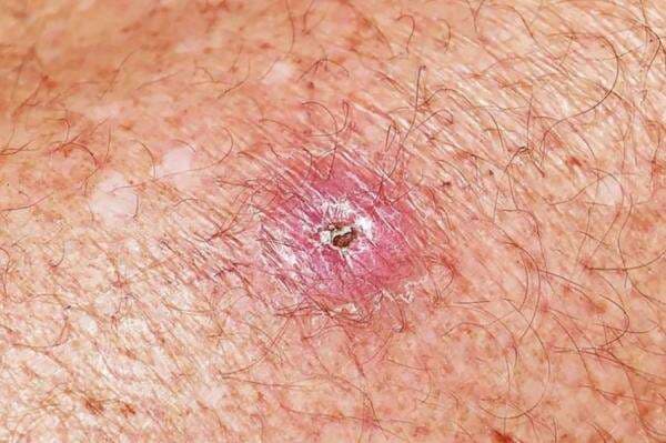 Bakteri Ganas di Balik Penyakit Bisul Akhirnya Terkuak Bakteri Ganas di Balik Penyakit Bisul Akhirnya Terkuak