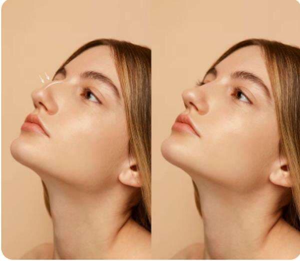 Berapa Lama Proses Penyembuhan Operasi Hidung? Berapa Lama Proses Penyembuhan Operasi Hidung?