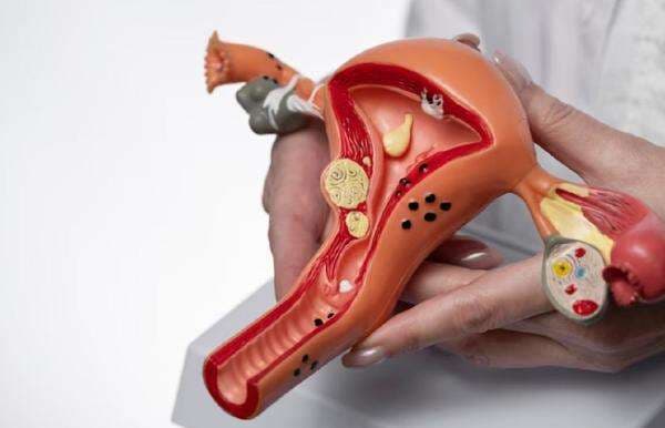 Berkaca Meninggalnya Shella Selpi Lizah, Kenali Gejala Kanker Ovarium Berkaca Meninggalnya Shella Selpi Lizah, Kenali Gejala Kanker Ovarium