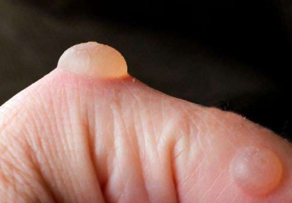 Bukan Pakai Pasta Gigi atau Kecap, Ini Pertolongan Pertama saat Kulit Melepuh Bukan Pakai Pasta Gigi atau Kecap, Ini Pertolongan Pertama saat Kulit Melepuh