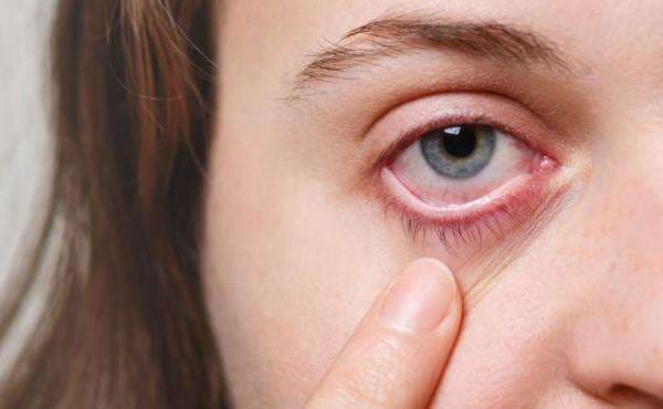 Cara Mengatasi Mata Merah karena Kembang Api Cara Mengatasi Mata Merah karena Kembang Api