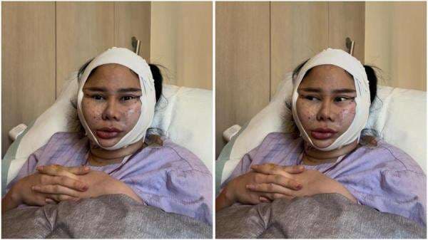 Muka Denise Chariesta Mendadak Bengkak dan Sulit Bicara, Ini Faktanya! Muka Denise Chariesta Mendadak Bengkak dan Sulit Bicara, Ini Faktanya!