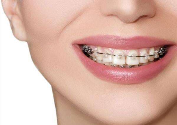 Hukum Memakai Behel dalam Islam Hukum Memakai Behel dalam Islam