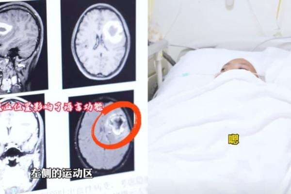 Idap Pendarahan Otak, Wanita Ini Tiba-tiba Tak Bisa Lagi Berbicara Bahasa Inggris Idap Pendarahan Otak, Wanita Ini Tiba-tiba Tak Bisa Lagi Berbicara Bahasa Inggris