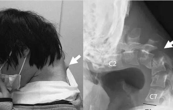 Keseringan Menggunakan Ponsel Diklaim Menyebabkan Kepala Tertunduk Keseringan Menggunakan Ponsel Diklaim Menyebabkan Kepala Tertunduk
